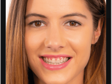 engage with aligners